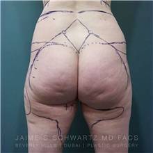 Buttock Implants Before Photo by Jaime Schwartz, MD; Beverly Hills, CA - Case 31073