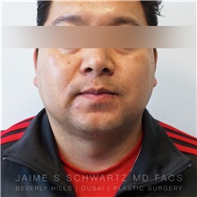 Liposuction After Photo by Jaime Schwartz, MD; Beverly Hills, CA - Case 31090