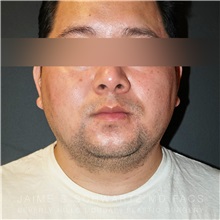 Liposuction Before Photo by Jaime Schwartz, MD; Beverly Hills, CA - Case 31090