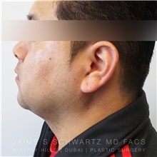 Liposuction After Photo by Jaime Schwartz, MD; Beverly Hills, CA - Case 31090
