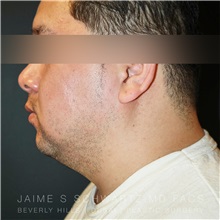 Liposuction Before Photo by Jaime Schwartz, MD; Beverly Hills, CA - Case 31090