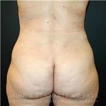 Liposuction After Photo by Jaime Schwartz, MD; Beverly Hills, CA - Case 31091