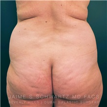 Liposuction Before Photo by Jaime Schwartz, MD; Beverly Hills, CA - Case 31091