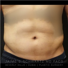 Liposuction After Photo by Jaime Schwartz, MD; Beverly Hills, CA - Case 31092