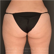 Buttock Implants After Photo by Jaime Schwartz, MD; Beverly Hills, CA - Case 31105