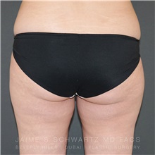 Buttock Implants Before Photo by Jaime Schwartz, MD; Beverly Hills, CA - Case 31105
