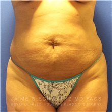 Tummy Tuck Before Photo by Jaime Schwartz, MD; Beverly Hills, CA - Case 31109