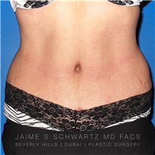 Tummy Tuck After Photo by Jaime Schwartz, MD; Beverly Hills, CA - Case 31112