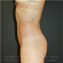 Liposuction After Photo by Jaime Schwartz, MD; Beverly Hills, CA - Case 31113