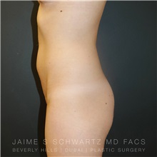 Liposuction Before Photo by Jaime Schwartz, MD; Beverly Hills, CA - Case 31113