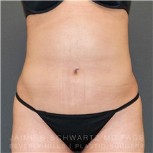 Liposuction After Photo by Jaime Schwartz, MD; Beverly Hills, CA - Case 31114