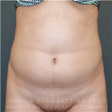Liposuction Before Photo by Jaime Schwartz, MD; Beverly Hills, CA - Case 31114