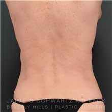 Liposuction After Photo by Jaime Schwartz, MD; Beverly Hills, CA - Case 31115