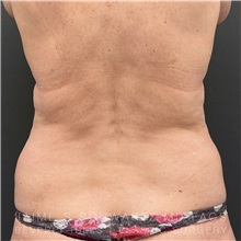 Liposuction Before Photo by Jaime Schwartz, MD; Beverly Hills, CA - Case 31115