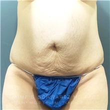 Tummy Tuck Before Photo by Jaime Schwartz, MD; Beverly Hills, CA - Case 31123