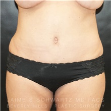 Tummy Tuck After Photo by Jaime Schwartz, MD; Beverly Hills, CA - Case 31124