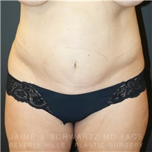 Tummy Tuck Before Photo by Jaime Schwartz, MD; Beverly Hills, CA - Case 31124