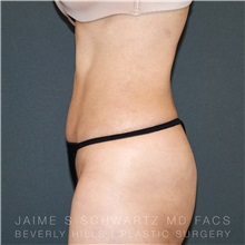 Liposuction After Photo by Jaime Schwartz, MD; Beverly Hills, CA - Case 31133