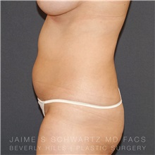 Liposuction Before Photo by Jaime Schwartz, MD; Beverly Hills, CA - Case 31133
