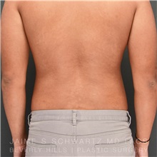 Liposuction After Photo by Jaime Schwartz, MD; Beverly Hills, CA - Case 31134