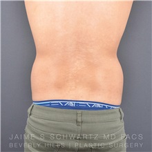 Liposuction Before Photo by Jaime Schwartz, MD; Beverly Hills, CA - Case 31134