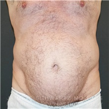 Tummy Tuck Before Photo by Jaime Schwartz, MD; Beverly Hills, CA - Case 31135