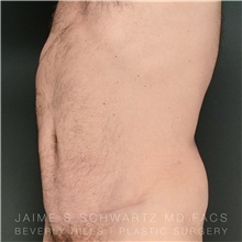 Tummy Tuck After Photo by Jaime Schwartz, MD; Beverly Hills, CA - Case 31135