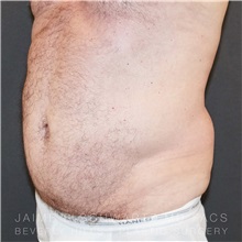 Tummy Tuck Before Photo by Jaime Schwartz, MD; Beverly Hills, CA - Case 31135