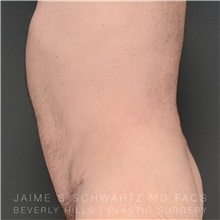 Tummy Tuck After Photo by Jaime Schwartz, MD; Beverly Hills, CA - Case 31135