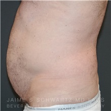 Tummy Tuck Before Photo by Jaime Schwartz, MD; Beverly Hills, CA - Case 31135