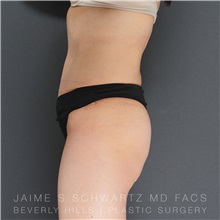 Tummy Tuck After Photo by Jaime Schwartz, MD; Beverly Hills, CA - Case 31136