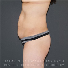 Tummy Tuck Before Photo by Jaime Schwartz, MD; Beverly Hills, CA - Case 31136