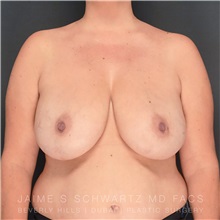 Breast Reduction Before Photo by Jaime Schwartz, MD; Beverly Hills, CA - Case 31256