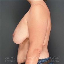 Breast Reduction Before Photo by Jaime Schwartz, MD; Beverly Hills, CA - Case 31256