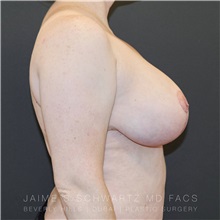 Breast Reduction After Photo by Jaime Schwartz, MD; Beverly Hills, CA - Case 31258