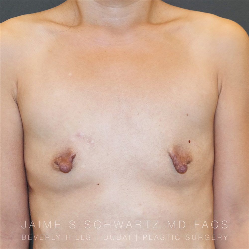 Breast Augmentation Before and After Photos by Jaime Schwartz, MD; Beverly  Hills, CA - Case 31262 | ASPS