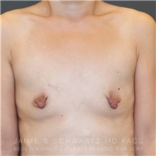 Breast Augmentation Before Photo by Jaime Schwartz, MD; Beverly Hills, CA - Case 31262