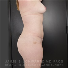 Tummy Tuck After Photo by Jaime Schwartz, MD; Beverly Hills, CA - Case 31268