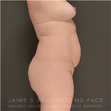 Tummy Tuck Before Photo by Jaime Schwartz, MD; Beverly Hills, CA - Case 31268