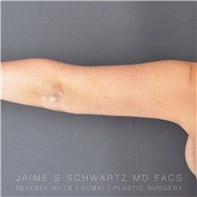 Arm Lift After Photo by Jaime Schwartz, MD; Beverly Hills, CA - Case 31272