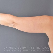 Arm Lift Before Photo by Jaime Schwartz, MD; Beverly Hills, CA - Case 31272