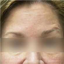 Botulinum Toxin After Photo by Jaime Schwartz, MD; Beverly Hills, CA - Case 31274