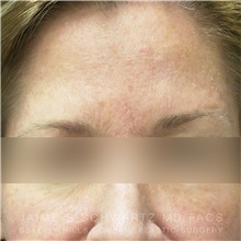 Botulinum Toxin After Photo by Jaime Schwartz, MD; Beverly Hills, CA - Case 31274