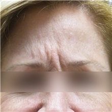 Botulinum Toxin Before Photo by Jaime Schwartz, MD; Beverly Hills, CA - Case 31274
