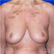 Breast Augmentation Before Photo by Jaime Schwartz, MD; Beverly Hills, CA - Case 31275