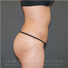 Buttock Lift with Augmentation After Photo by Jaime Schwartz, MD; Beverly Hills, CA - Case 31343