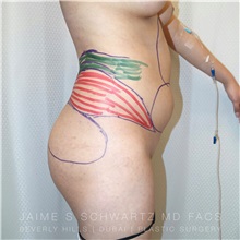 Buttock Lift with Augmentation Before Photo by Jaime Schwartz, MD; Beverly Hills, CA - Case 31343