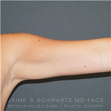 Arm Lift After Photo by Jaime Schwartz, MD; Beverly Hills, CA - Case 31354