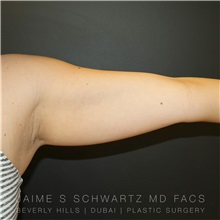 Arm Lift Before Photo by Jaime Schwartz, MD; Beverly Hills, CA - Case 31354
