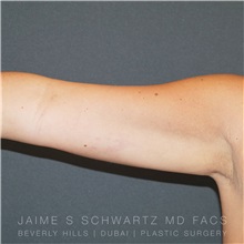 Arm Lift After Photo by Jaime Schwartz, MD; Beverly Hills, CA - Case 31354